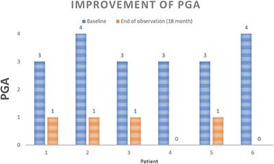 Successful Treatment of Refractory Palmoplantar Pustular Psoriasis With Apremilast: A Case Series